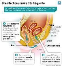 Causes Infection Urinaire Femme