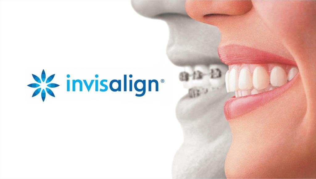 Invisalign Prix 