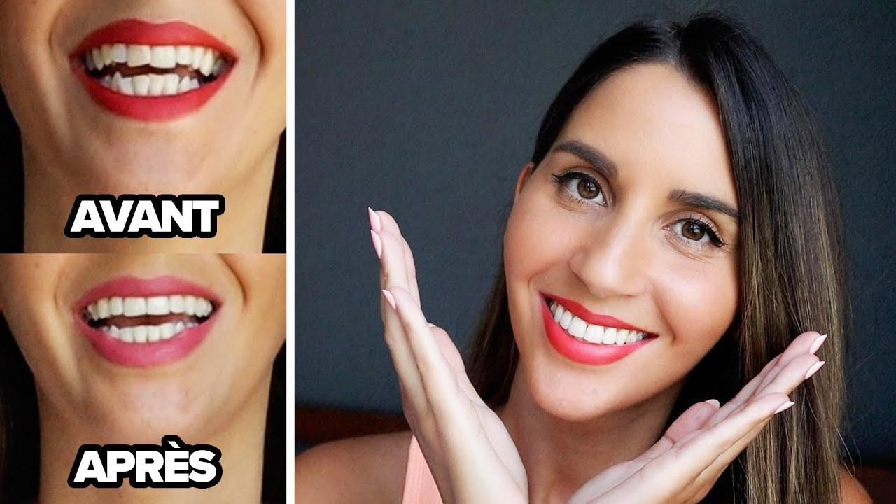 Invisalign Prix