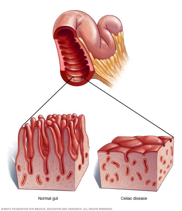 celiac maladie