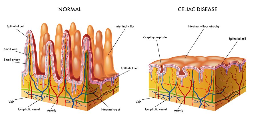 celiac maladie