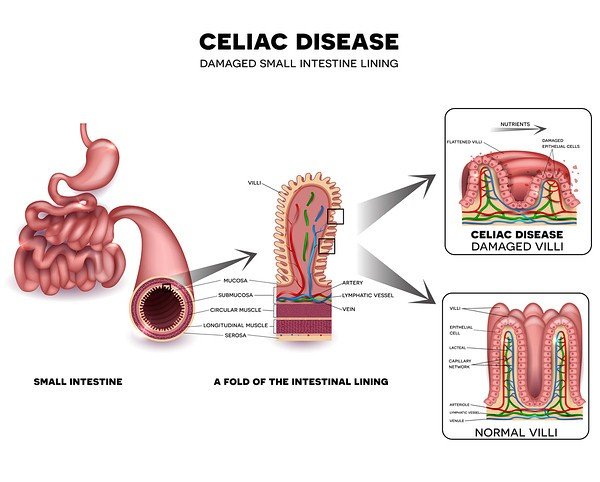 celiac maladie