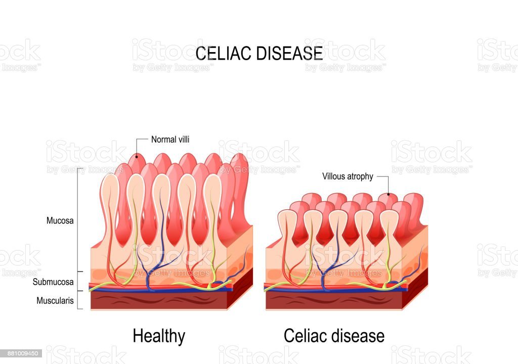 celiac maladie