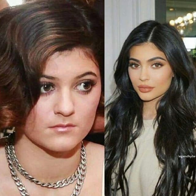 Kylie Jenner Avant Chirurgie