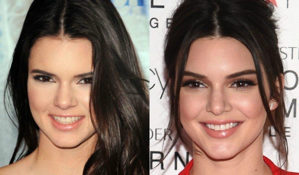 Kendall Jenner Chirurgie