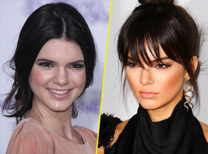Kendall Jenner Chirurgie